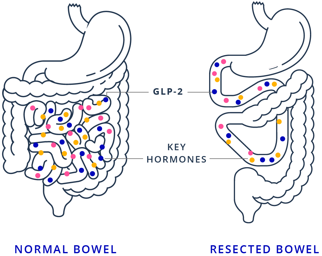 Image of Normal Bowel vs Resected Bowel